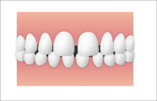 空隙歯列(すきっ歯)